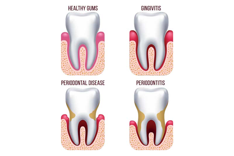 A fogágybetegség (parodontitis) okai, tünetei és kezelési lehetőségei